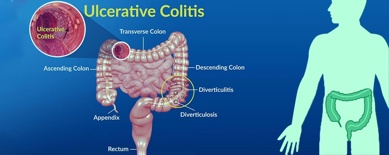 Ulcerative Colitis and Proctitis - Gastroenterologist